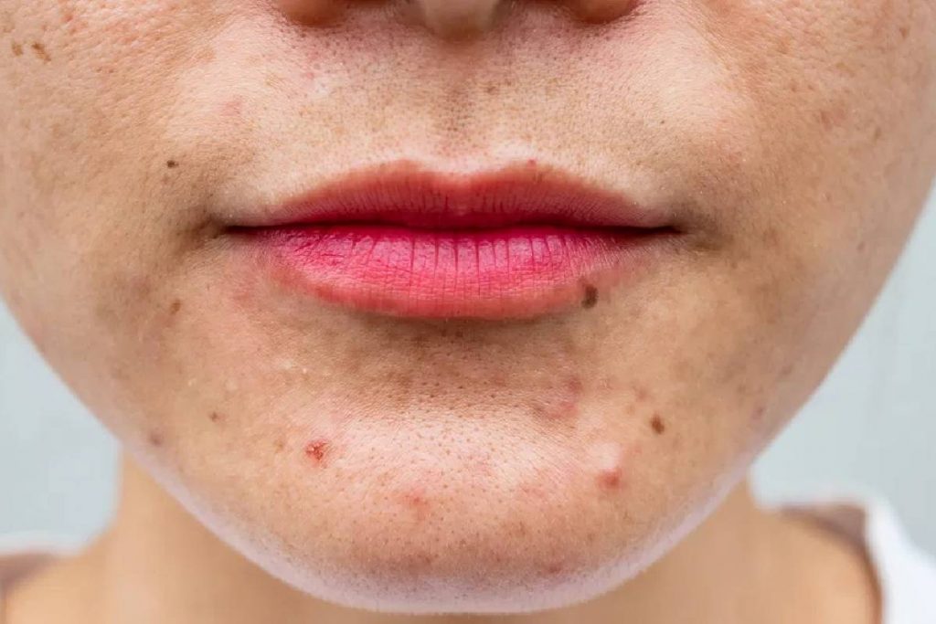 Skin Bumps