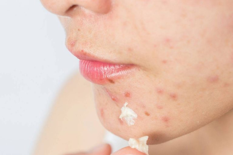 Acne Scars
