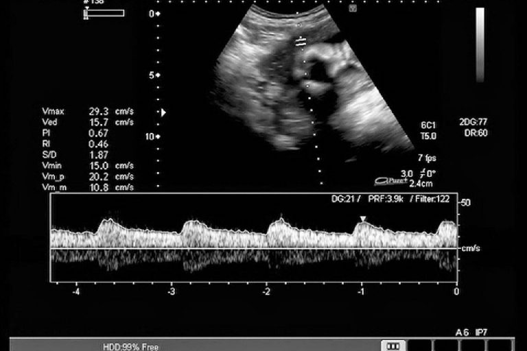 Fetal Heart Monitoring