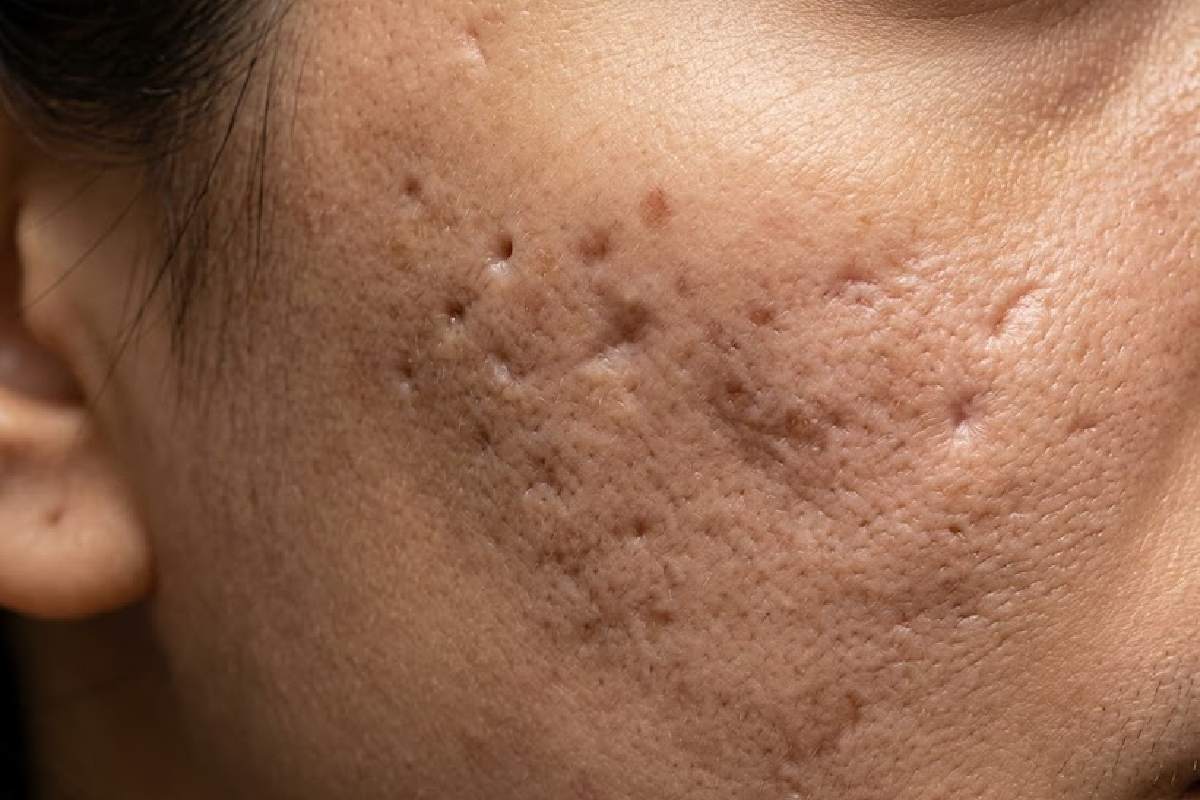 How to Treat Acne Scars Effectively at Home